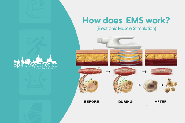 EMS treatment for post pregnancy weight loss treatment New Scarborough