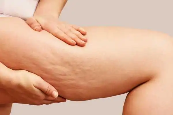 Image of woman showing leg with cellulite New Scarborough