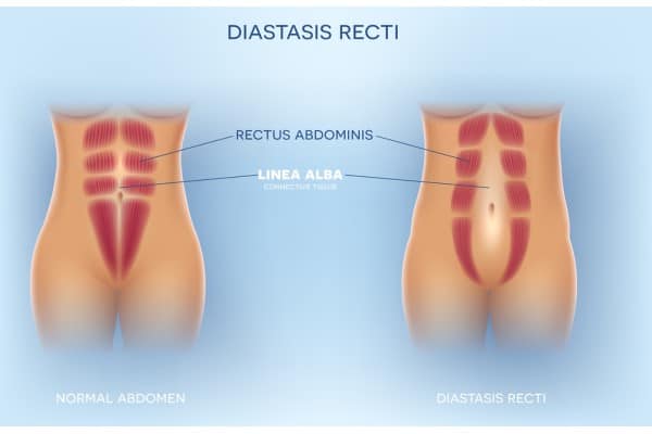 What Non-Surgical Options Are Available for Diastasis Recti New Scarborough?