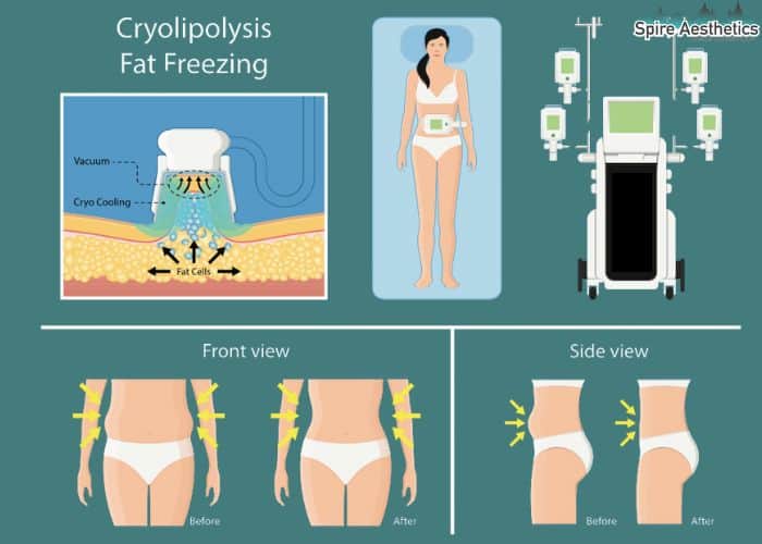 Image of diet and fat freezing combined for best results for Spire Aesthetics New Scarborough