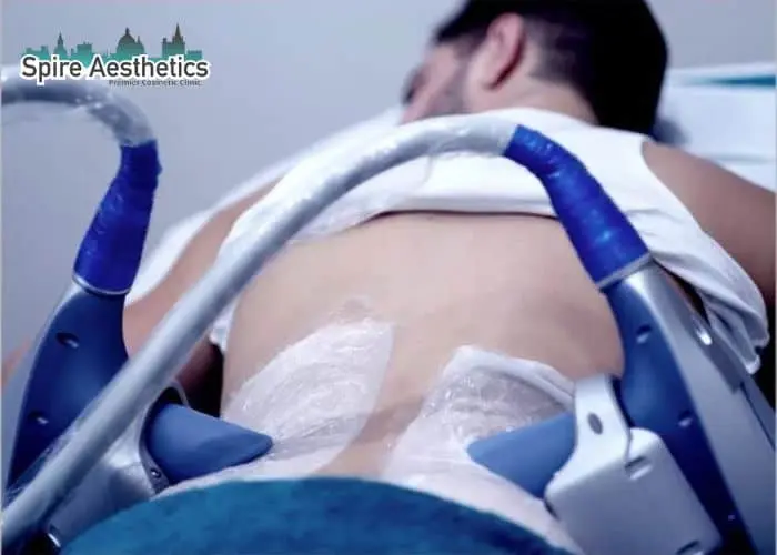 Man having fat freezing treatment done on love handles before a competitions New Scarborough to create a sculpted look.