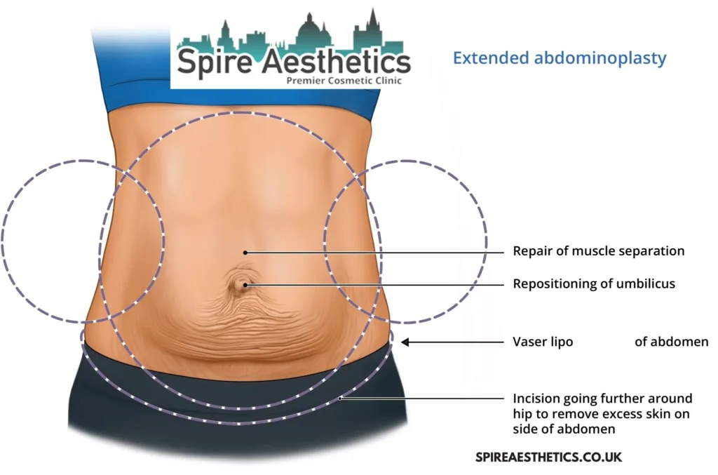 Understanding Loose Skin After Gastric Band New Scarborough Surgery and HIFU Treatment