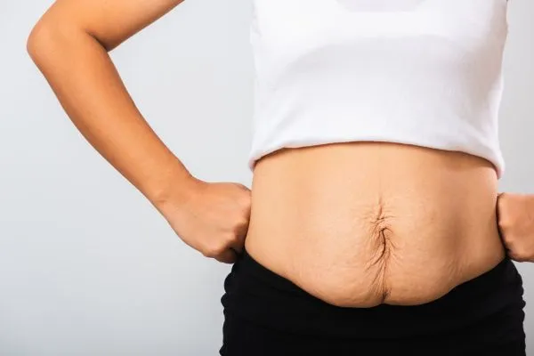 Image of a woman's stomach after weight loss with sagging skin following a gastric band New Scarborough