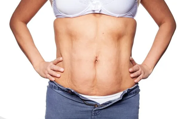 sagging skin on woman's stomach after weight loss injections New Scarborough