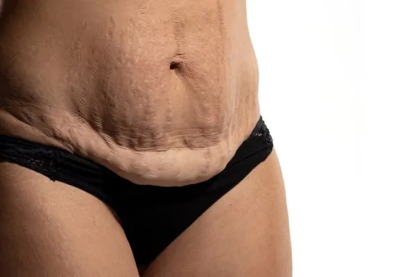 Image of womans stomach after weight loss injections New Scarborough showing saggy skin