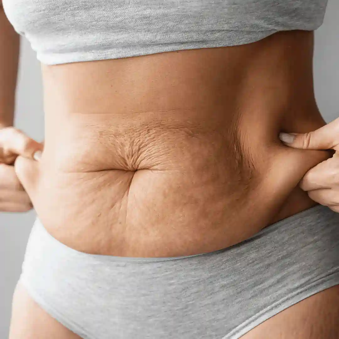Is It Normal to Have Loose Skin After Pregnancy New Scarborough?